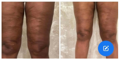 (image for) Cellulite Gone- No Weight Loss No Gym Routine